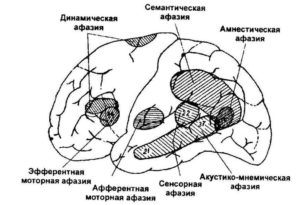 афазия классификация локализация